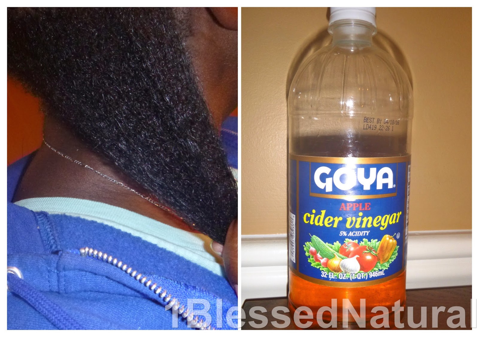 Apple Cider Vinegar And Seborrheic Dermatitis